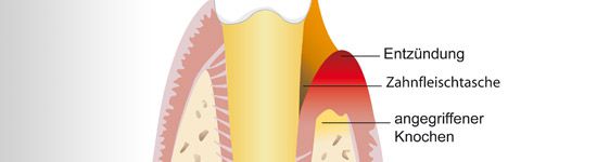 Parodontitisbehandlung